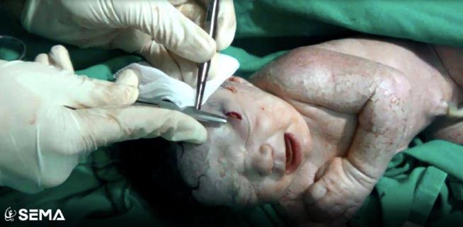 Syrian Baby Born With Shrapnel Wound