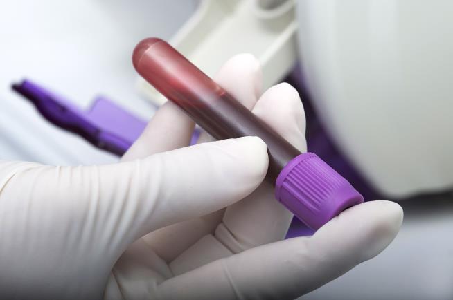 Blood Test Could Get Rid of 'Coin-Tossing' on Alzheimer's