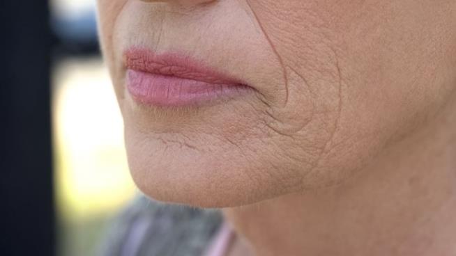 New Anti-Wrinkle Drug May Be Botox Rival