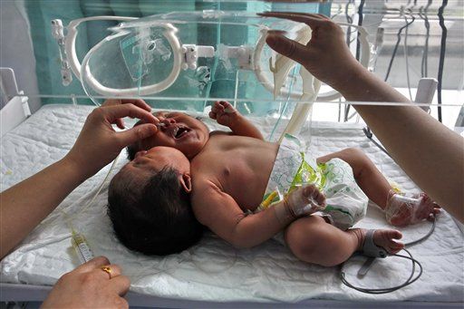 Conjoined Girls With Single Body, 2 Heads Born in China