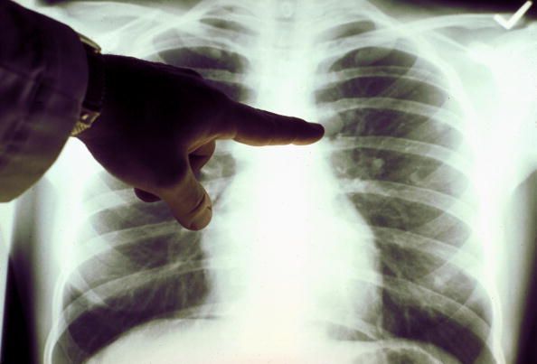 Desperate Europeans Try to Sell Kidneys, Lungs