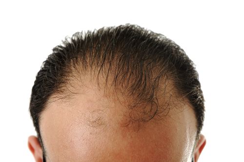 Researchers Inch Toward Baldness Cure