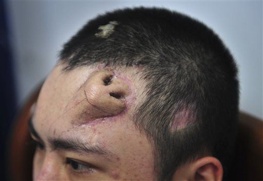 Man Grows New Nose ... on His Forehead