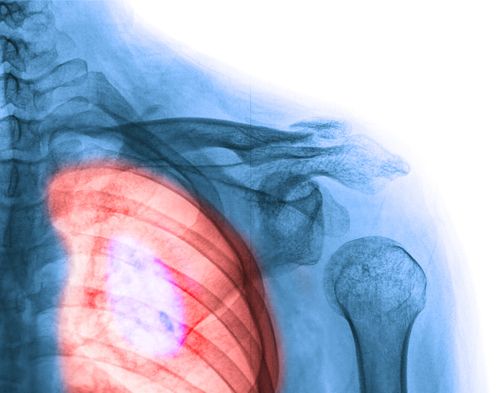 Lung Cancer Drug Could Be 'Game-Changer'