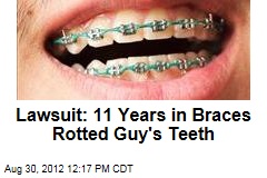 Lawsuit: 11 Years in Braces Rotted Guy&#39;s Teeth