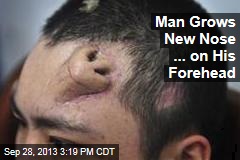 Man Grows New Nose ... on His Forehead