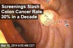 Screenings Slash Colon Cancer Rate 30% in a Decade
