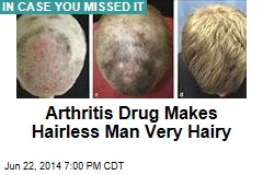 Arthritis Drug Makes Hairless Man Very Hairy