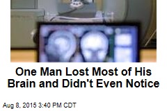 One Man Lost Most of His Brain and Didn&#39;t Even Notice