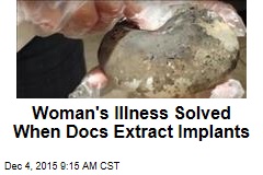 Woman&#39;s Illness Solved When Docs Extract Implants
