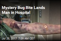 Bruises Spread Rapidly After Mystery Bug Bites