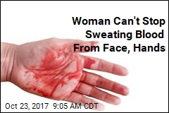 Woman Can&#39;t Stop Sweating Blood From Face, Hands