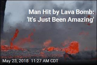 Man Hit by Lava Bomb: &#39;It&#39;s Just Been Amazing&#39;