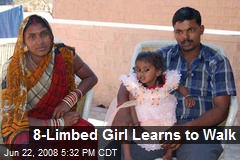 8-Limbed Girl Learns to Walk
