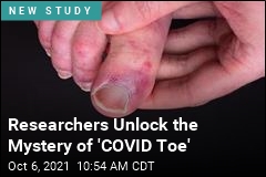 Researchers Unlock the Mystery of &#39;COVID Toe&#39;