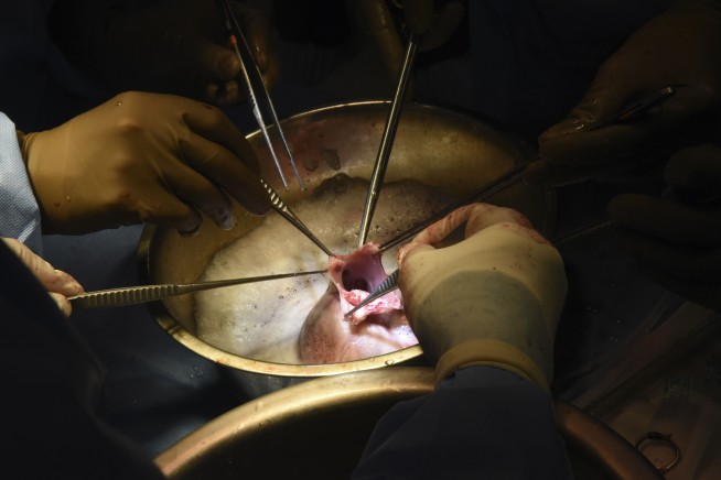 Surgeons perform second pig heart transplant, trying to save a dying man