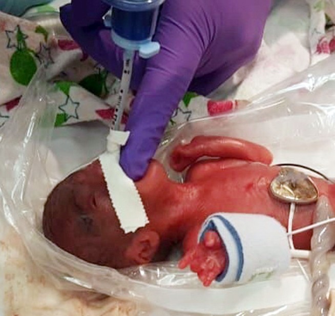 Girl believed to be tiniest newborn weighed as much as apple