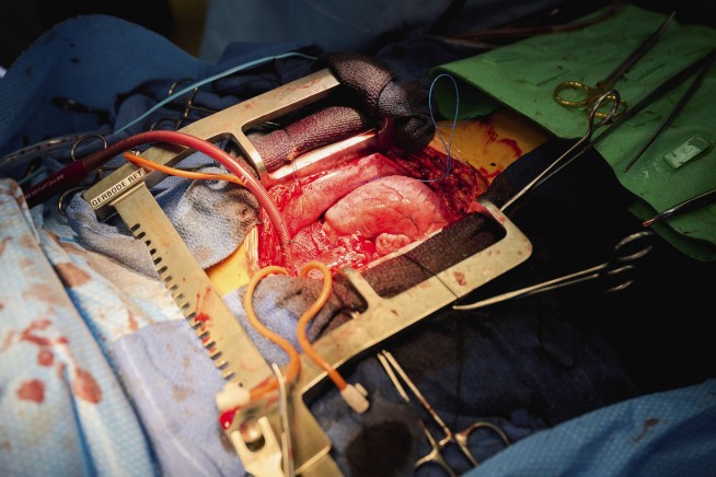 Pig organ transplants inch closer with testing in the dead