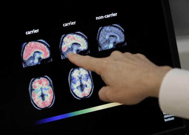 Studies in healthy older people aim to prevent Alzheimer's