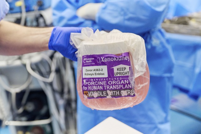 An Alabama woman is doing well after the latest experimental pig kidney transplant