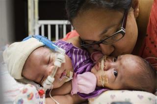 After Plenty of Faith, Hope, Conjoined Twins Separated