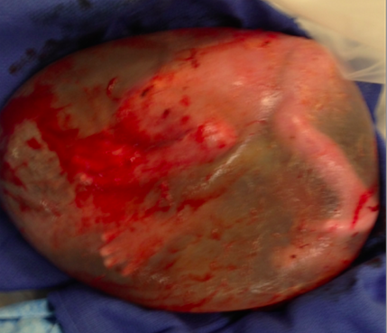 Baby Born 3 Months Early —Still Inside Amniotic Sac