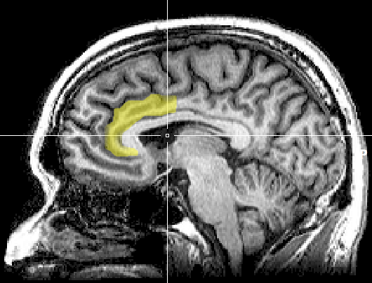 To Treat OCD, Surgeons Remove Half-a-Teaspoon of Brain