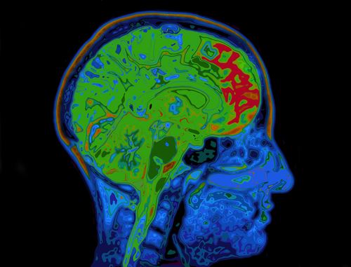 Modern Malady May Be Behind Rise in Dementia