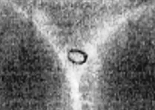 Stolen Diamond Ring Found Inside Alleged Thief