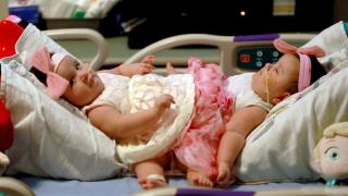 Conjoined Sisters Separated in Texas
