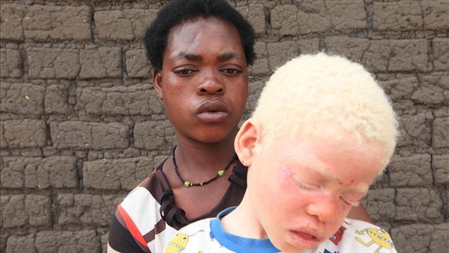 Human Albinos in Malawi Hunted Like 'Animals'