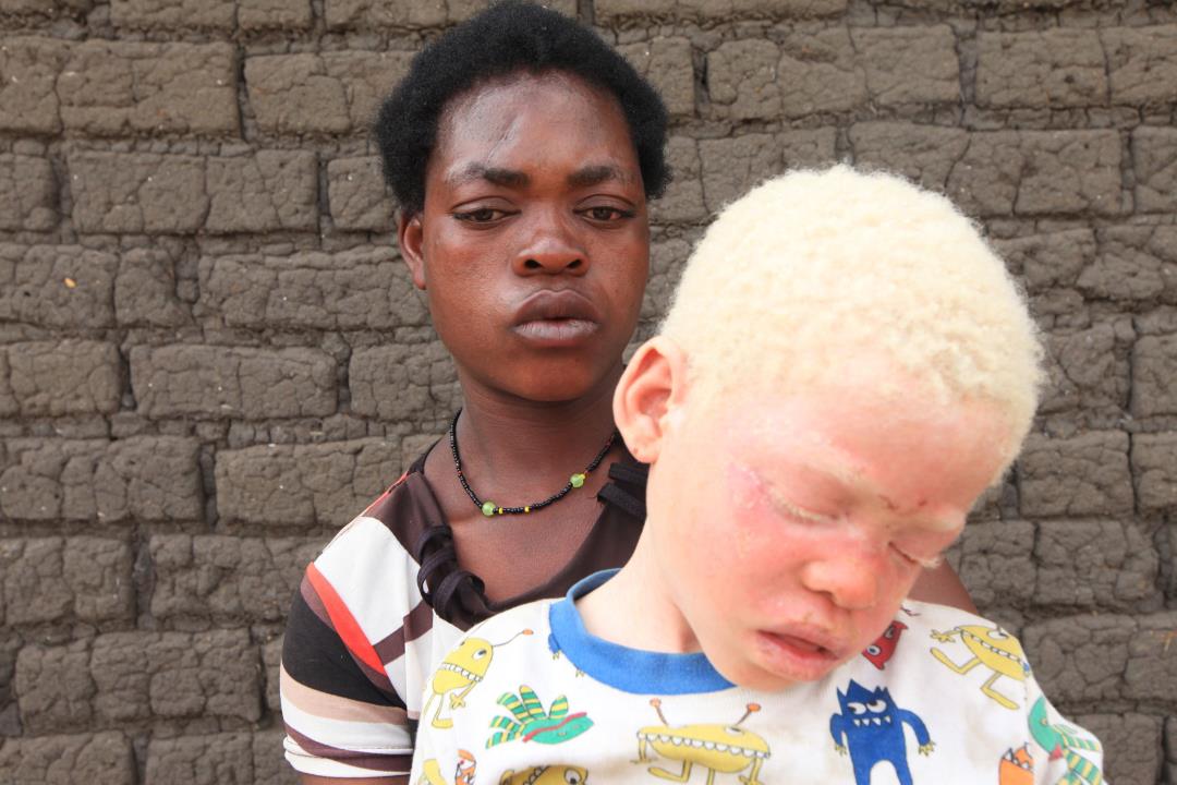 albino, albinism, Malawi, Africa, murder, body parts, rape, harassment, sub...