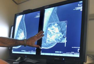 Women to See 60% Spike in Cancer Deaths by 2030