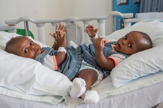 Conjoined Twins From Nigeria Separated at Tenn. Hospital