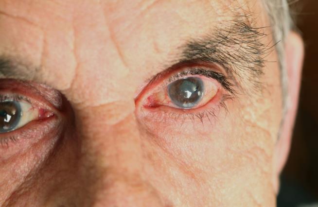 Cataract Surgery May Have Big Bonus Besides Better Sight