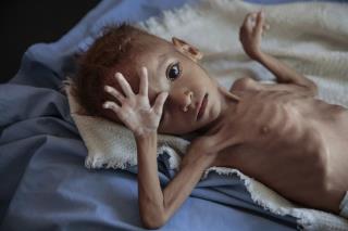 'A Death Sentence' for Kids Under 5 in Yemen