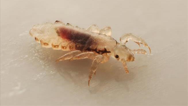 Years-Long Lice Infestation May Have Indirectly Killed Girl