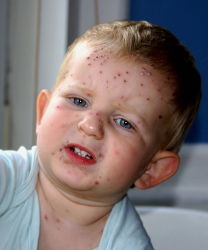 US Scratches Out Scourge of Chickenpox