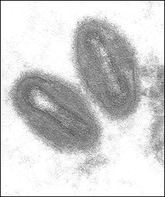 2nd US Case of Monkeypox Emerges