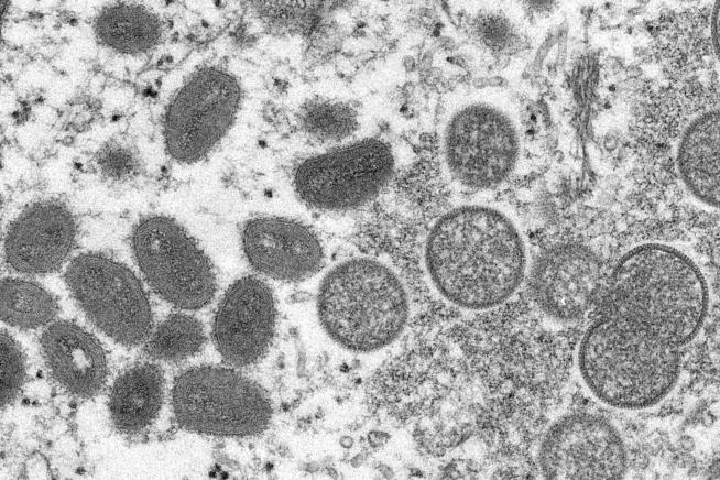 200 Monkeypox Cases Seen in 20 Nations