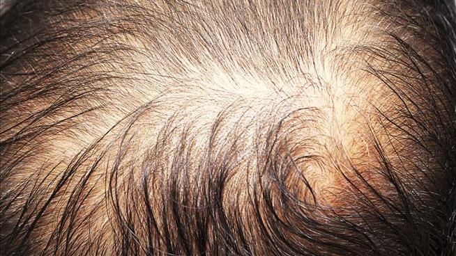 Pop a Pill to Reverse Hair Loss? That Drug Already Exists