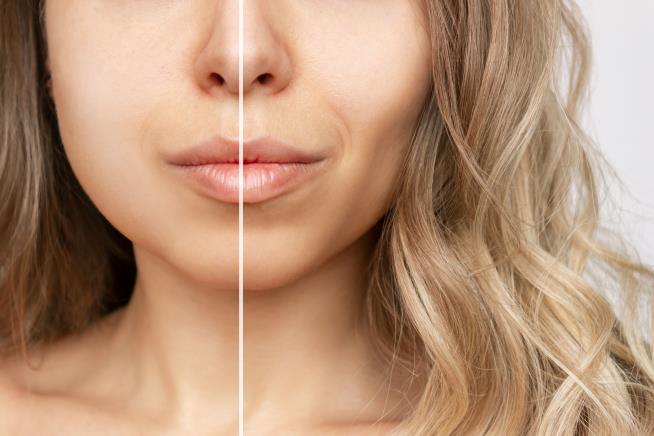 People Are Paying Big Bucks to Get Rid of Face Fat