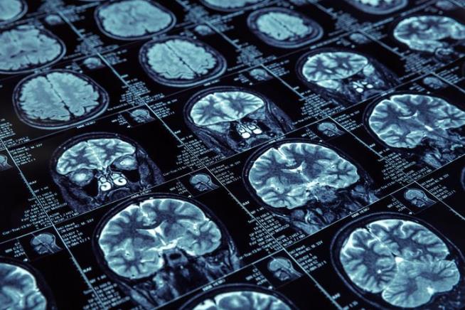 Man's Brain Mutation Suggests a Way to Treat Alzheimer's