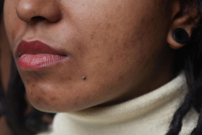 In Dating and Hiring Decisions, Acne Factors In