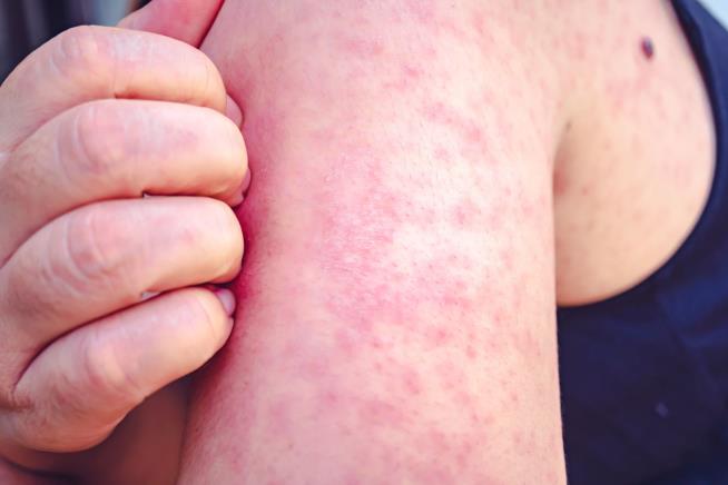 Rise in Measles Cases Prompts CDC Warning