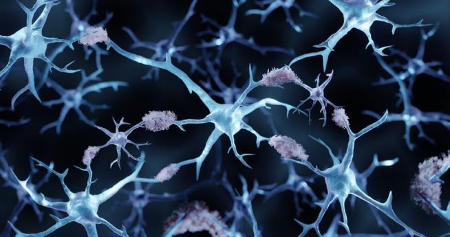 Research May Result in Big Spike of Alzheimer's Diagnoses