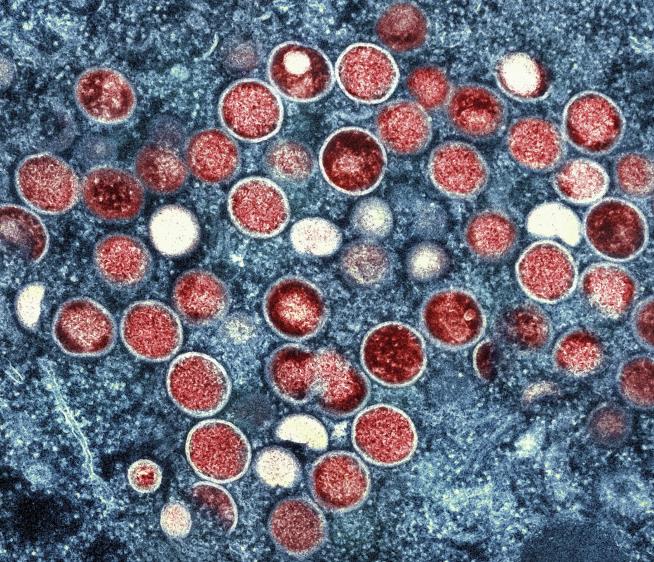 First Case of Highly Contagious Mpox Found in Sweden