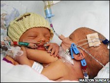 Surgery Looms for Teen Mom's Conjoined Newborns
