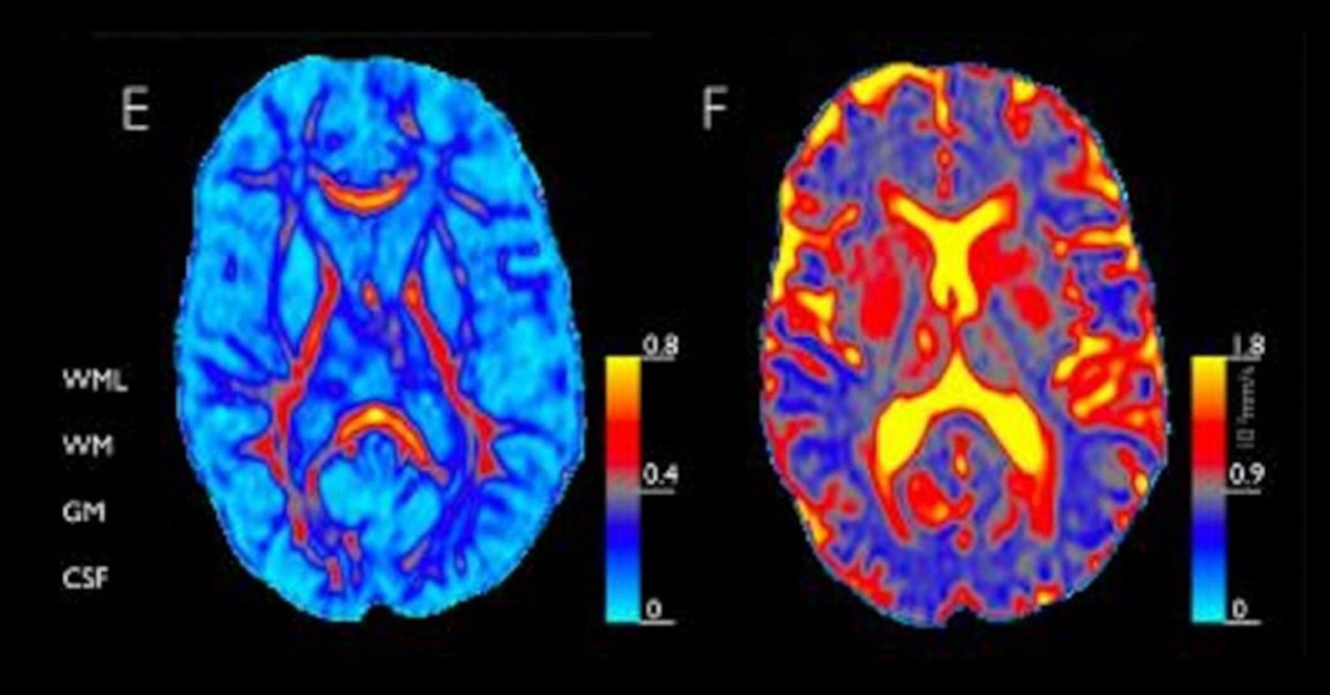 New Study Reveals #1 Cause of Dementia (You'll Be Surprised)