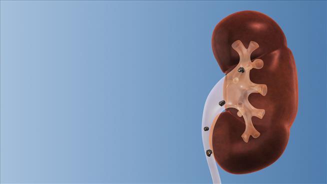 A New Peril of Modern Life for Kids: Kidney Stones